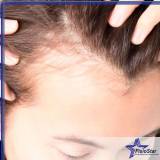 clínica para tratamento para queda de cabelo Lapa