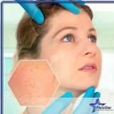 peeling facial para acne e manchas