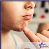 tratamento facial para acne Instituto da Previdência