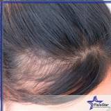 tratamento para queda de cabelo Interlagos