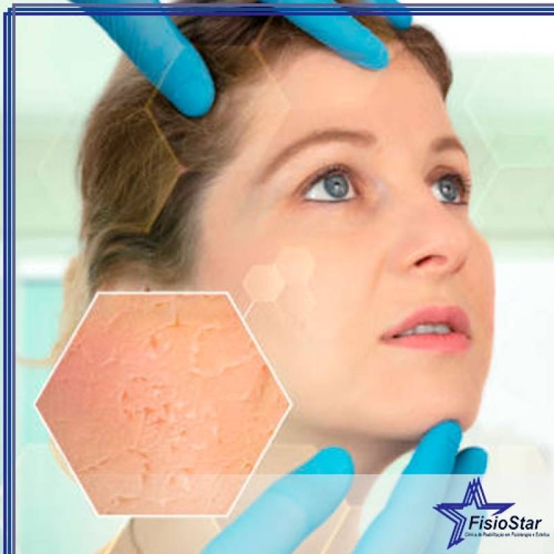 Tratamento Facial para Acne Valor Cidade Dutra - Estética para Afinar o Rosto